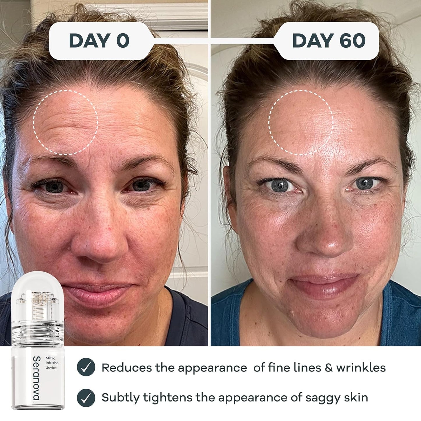 Radiant Skin Micro Infusion System™